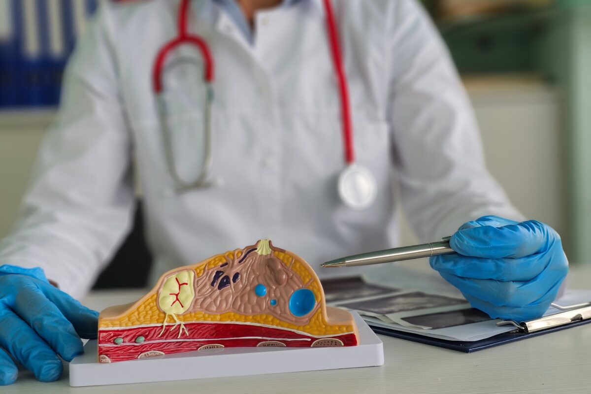 riscul de cancer mamar